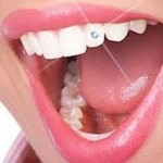 Bijuterie dentara